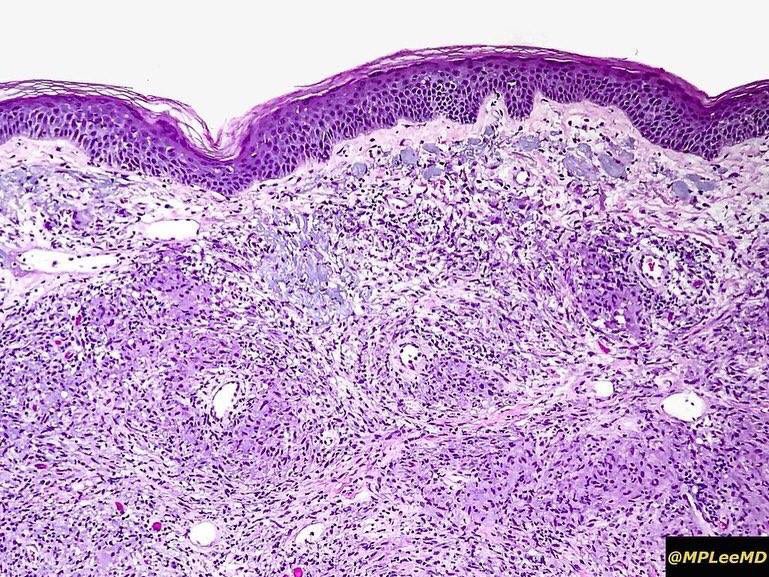 MPLEEMD's tweet image. Lepromatous leprosy. Mycobacterium Leprae infection in immune compromised. Granulatomous inflammation packed with organisms; +/-perineural inv. Nerve dmg --&amp;gt; can't feel that I just stepped on a nail -&amp;gt; infection --&amp;gt;deformity. Armadillo carrier.  #dermatology #dermpath #patholo