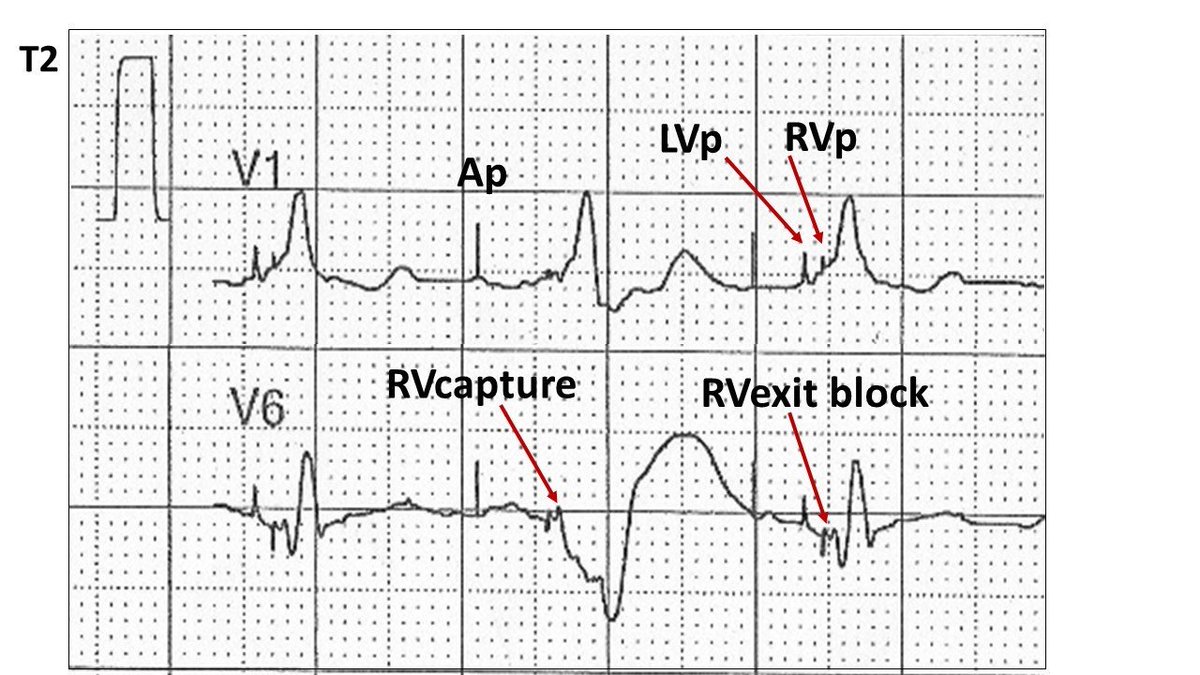 prof_mond's tweet photo. The left ventricular stimulus artefact (LVp) is ~ 60ms prior to the right ventricular stimulus artefact (RVp). V1 shows initial left ventricular pacing.
The second complex shows biventricular capture (RVcapture) and the next complex right ventricular exit block (RVexit block) https://t.co/wKu7Q4jNq5