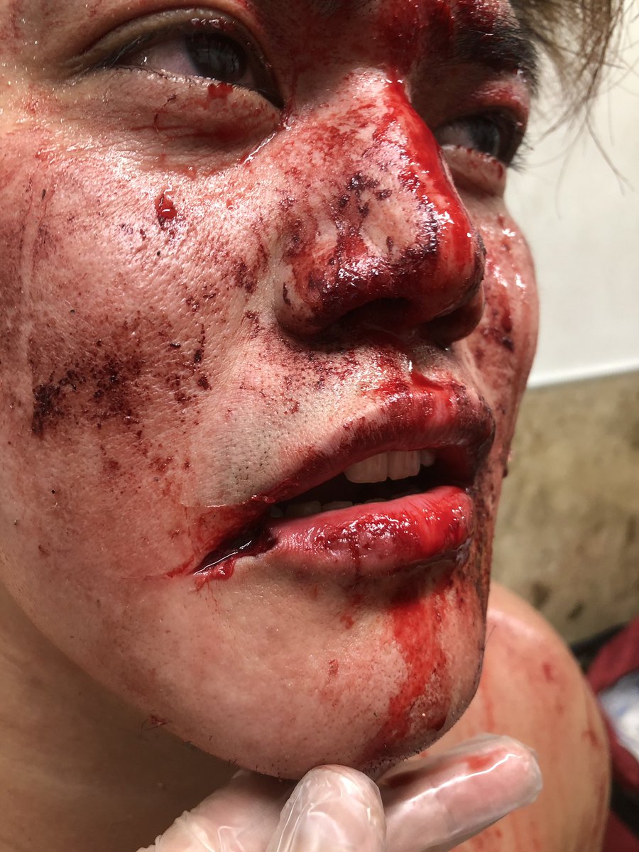 吉野 Superref 恵悟 On Twitter 流血 グロ注意 色んな死闘が詰まったフリーダムズ後楽園大会 ありがとうございました 本格デスマッチ界参入となったいつもアレな杉浦が口裂けて大流血しながらも受けまくってドカンドカン客席湧かせてて 少し見直しました