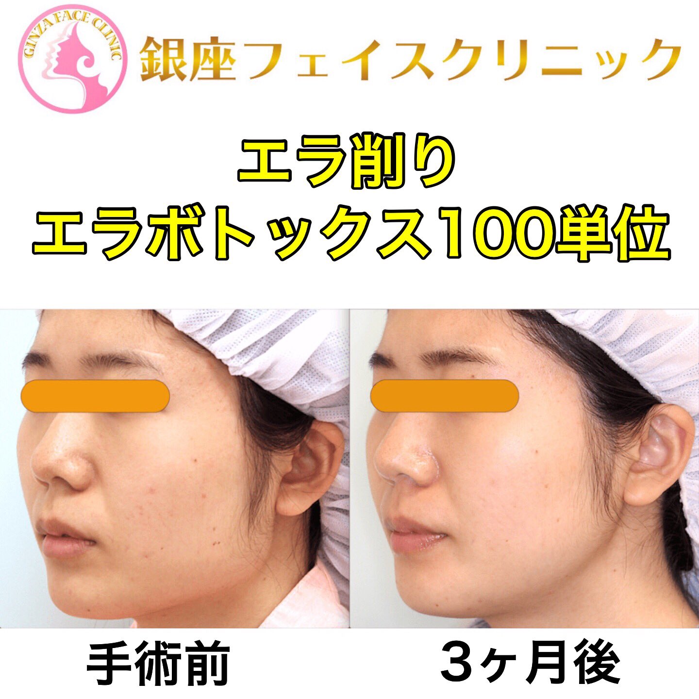 奥田宗央 輪郭手術の匠 בטוויטר エラ削り エラボトックス 費用 通常価格 1 687 000円 目隠しモニター 1 487 000円 全顔モニター 1 287 000円 健康保険は使えません リスク 内出血 感染 アレルギーなど 銀座フェイスクリニック 症例写真 美容整形