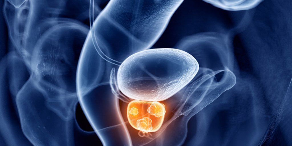 MedscapeOnc's tweet image. Unsure whether to opt for conservative active surveillance or radical treatment for nonmetastatic prostate cancer? Use this new, novel, free online tool. ms.spr.ly/6011T1EIF #EAU2019