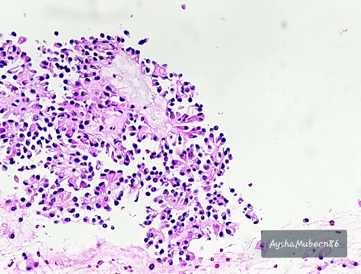AMubeen_Path's tweet photo. Solid pseudopapillary neoplasm of pancreas it is 👏
➡️young female,tail mass
➡️cyto:papillary fronds,bland tumor cells,hyaline globules,nuclear grooves
➡️DDX:PNET(SPN can be NE markers+ mostly CD56, Synpato less chromo)
➡️nuclear beta-catenin+(CTNNB1 mutation)
#GIpath
#pathboards https://t.co/0H3dors5Vy