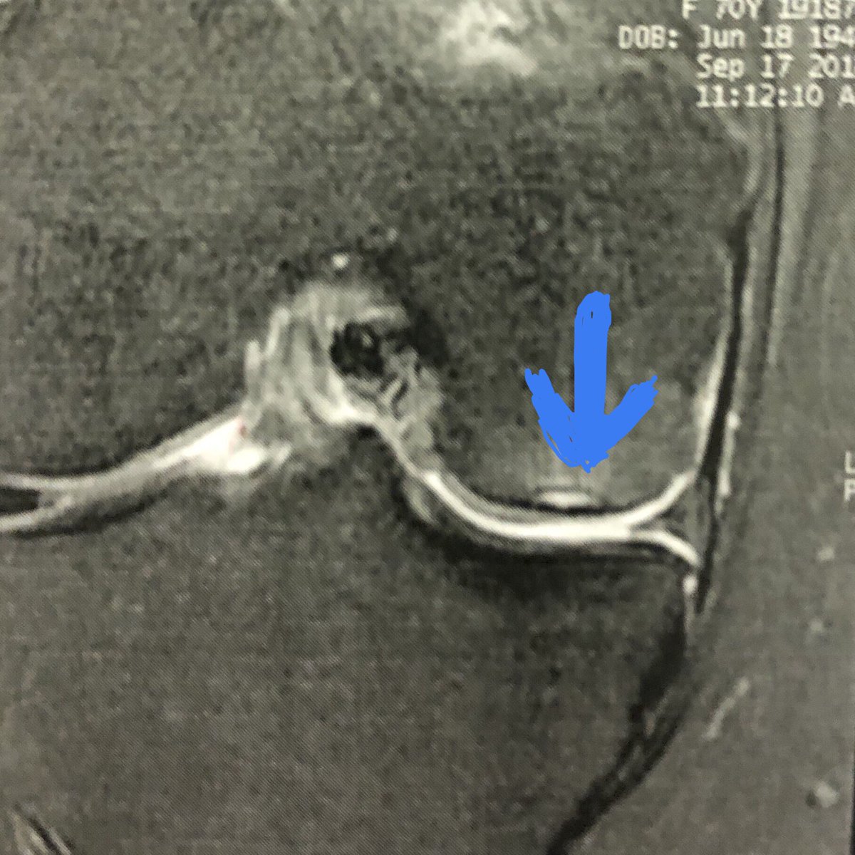 DrAdrianBarrera's tweet photo. La osteonecrosis avascular postmeniscectomia:🔹3 veces ➕ común en mujeres y🔹4 veces ➕común en > 60 años. Es una indicación en #protesis #rodilla #unicompartimental ya que preserva stock óseo una ventaja Vs protesis total rodilla. @ICJRortho @ClinicaCEMTRO https://t.co/mqTxVdNoOo
