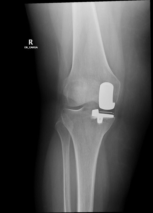 DrAdrianBarrera's tweet photo. La osteonecrosis avascular postmeniscectomia:🔹3 veces ➕ común en mujeres y🔹4 veces ➕común en > 60 años. Es una indicación en #protesis #rodilla #unicompartimental ya que preserva stock óseo una ventaja Vs protesis total rodilla. @ICJRortho @ClinicaCEMTRO https://t.co/mqTxVdNoOo