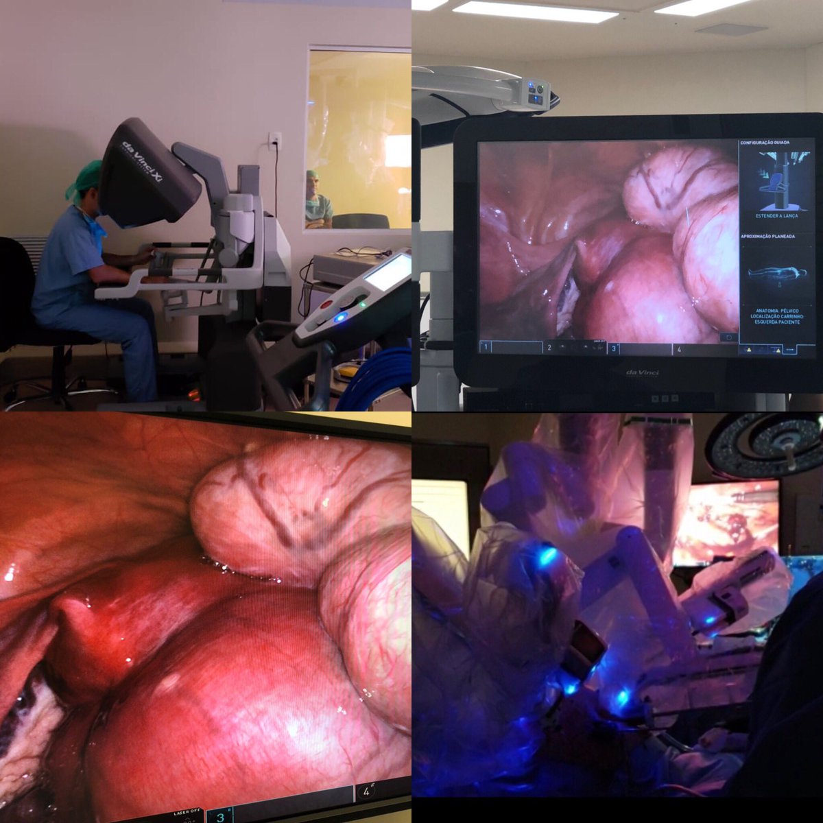 Thiersoares's tweet photo. Robotic Myomectomy. Fifteen myomas. #mioma #fibroidsurgery #myoma #myomectomy #miomectomia #morcelamentoseguro #morcelamento #morcelamentouterino #morcellation #containedmorcellation #endometriose #endometriosis #laparoscopia #laparoscopy #cirurgiarobótica #roboticsurgery https://t.co/kSyBYHA0E6