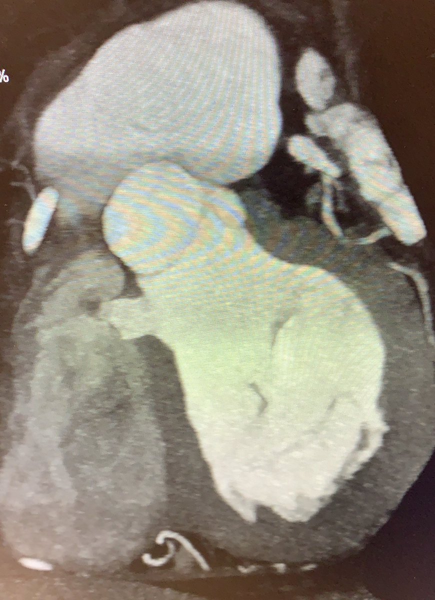 drozgeozden's tweet image. Coincidental finding of a CCTA.. Aneurysm of membraneous septum❣️#multimodalityimaging#yesCCT