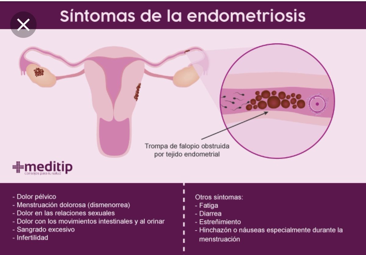 Endometriosis alimentos prohibidos