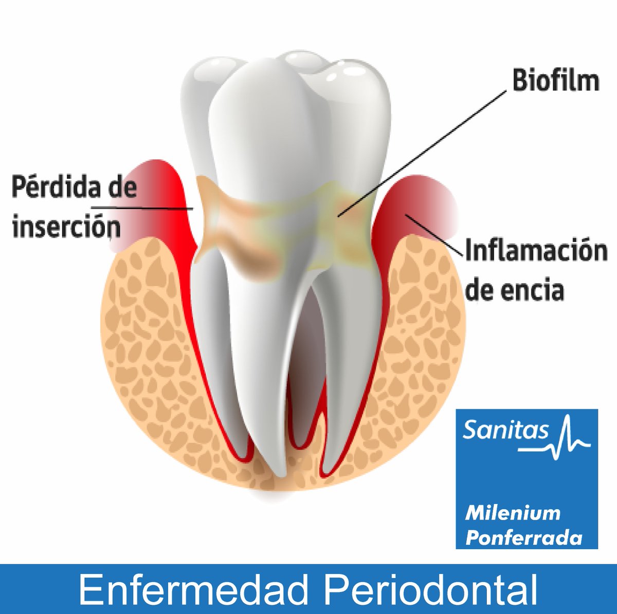 MDPonferrada's tweet photo. 🤚Una vez al año deberíamos acudir al dentista. Es la mejor manera de detectar la #Periodontitis o inflamación severa de las encías y estructuras que sostienen los dientes. Ver Info 👉 https://t.co/slNuQjSODg
🖥️ https://t.co/G0ErLbFSSE https://t.co/GhdmyOaUIy