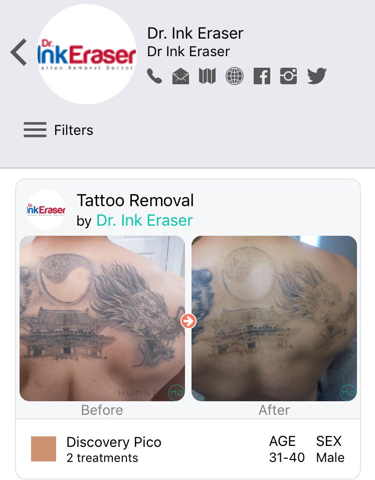 HumazeMD's tweet photo. After just 2 laser treatments using the @QuantaLaser Discovery Pico at @tattooremovalga in #atlanta. See more #beforeandafter photos like this on the #humazemd iOS app or go to our website. Link in bio.
#lasertattooremoval #tattoos #laser #artwork #skincare #ink #inked #artwork https://t.co/toDcdr0Pxo