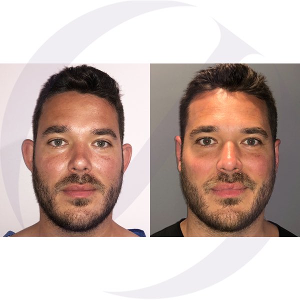 Dr_OscarJunco's tweet photo. ¿Sabías que las orejas de soplillo, un complejo que afecta a niños y adultos tiene una sencilla solución de rápida recuperación? #otoplastia #orejas👂🏼 #cirugíaestética #drjunco https://t.co/vqDjSe6X0c