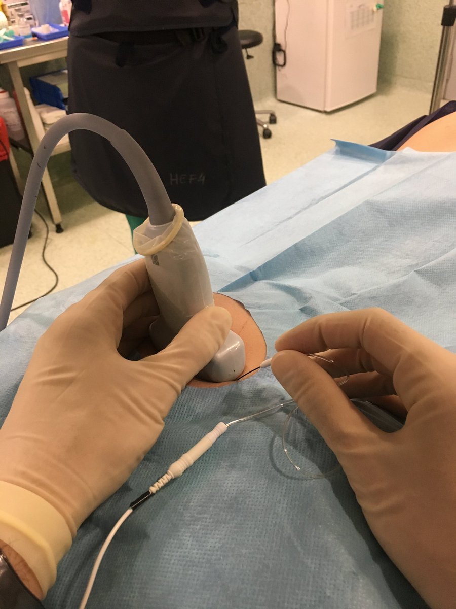 herrero_dr's tweet photo. Pudendal neuralgia treated with pulsed radiofrequency. Needle placement confirmed by Sonography, Fluoroscopy and Neurostimulation #chronicpain #interventionalmanagement #neuropathicpain #radiofrequency @HMHOSPITALES https://t.co/HldMbI9RMh