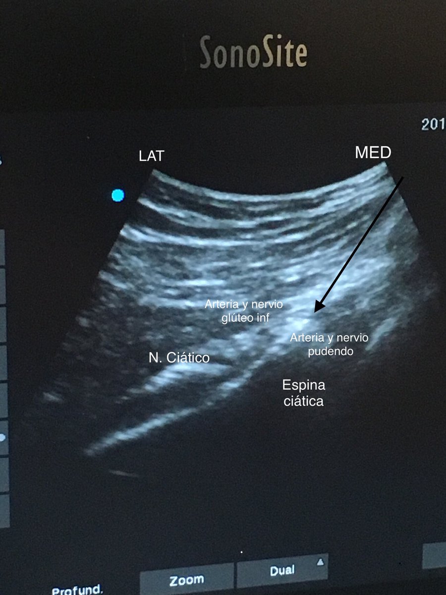 herrero_dr's tweet photo. Pudendal neuralgia treated with pulsed radiofrequency. Needle placement confirmed by Sonography, Fluoroscopy and Neurostimulation #chronicpain #interventionalmanagement #neuropathicpain #radiofrequency @HMHOSPITALES https://t.co/HldMbI9RMh