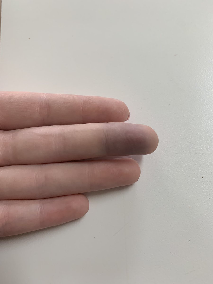 1991Shitposting's tweet photo. I broke my finger in the middle of a goodwill and everyone heard it. https://t.co/T1KR8Vqy4S