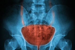 DStrovski's tweet photo. Causes of bladder cancer include:
•Smoking 
•Exposure to chemicals
•Past radiation exposure
•Chronic irritation of the bladder
•Parasitic infections https://t.co/nfW0915MtE