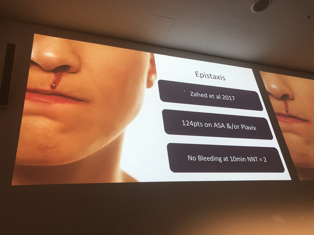 jeremyfaust's tweet photo. Per @srrezaie : Epistaxis management for patients ON ASPIRIN OR PLAVIX? Yup. Still works. And fast. No need for balloon in most cases. #smacc #emupdates https://t.co/okkXctT6TN