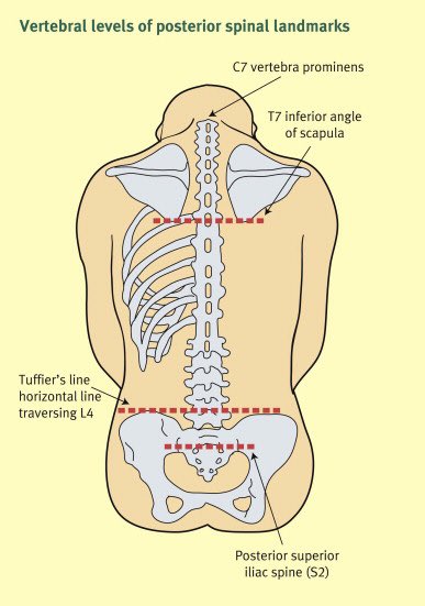 Intraspinal Analgesia (Epidural and Intrathecal) | Basicmedical Key