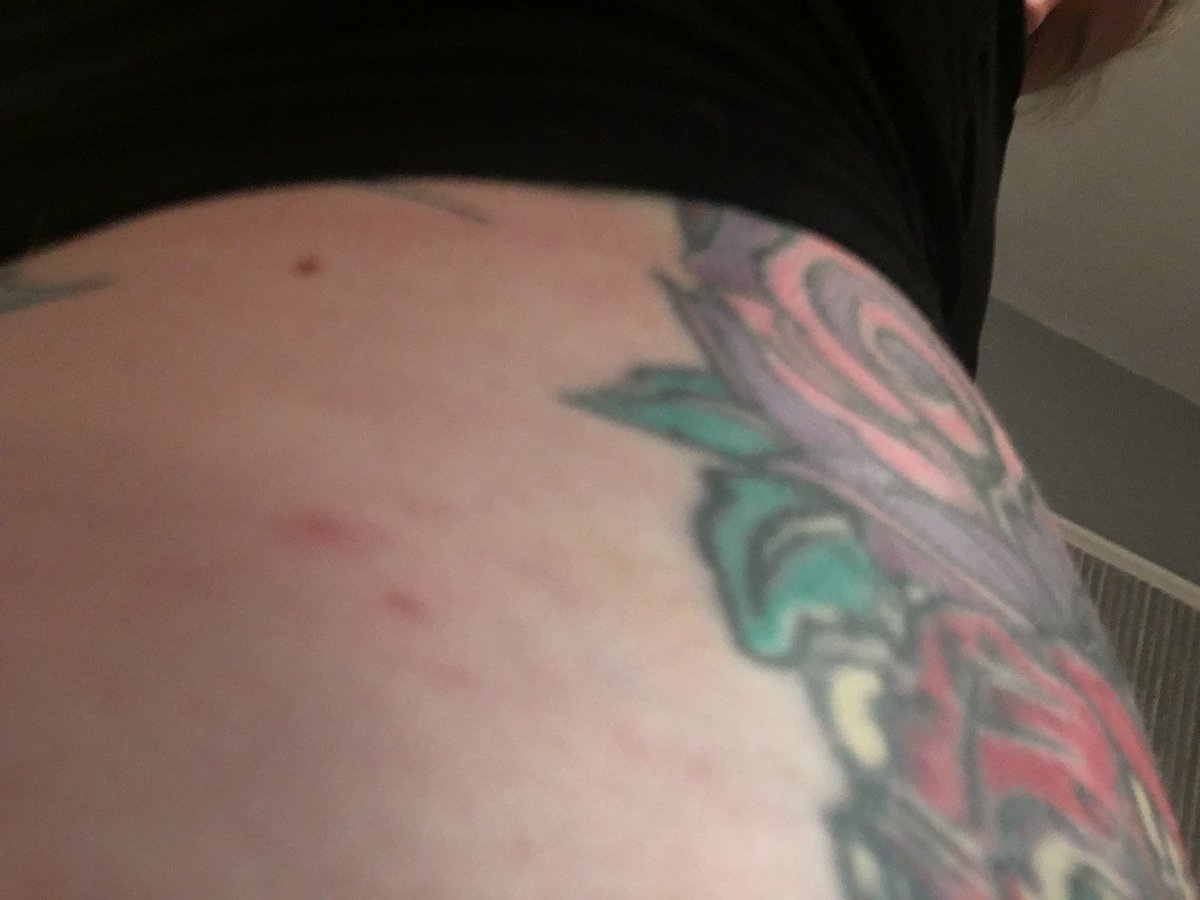 Shingles n my fat ass! I’ve been very quiet cause I’ve been poorly! Been off sick for over a week. Got back to work to find my illness in question!💁‍♀️ Here! See my fat ass n my shingles! 🤣 Apparently these pics are ‘Gross Misconduct’! Gross maybe! Lies or misconduct No! 💁‍♀️