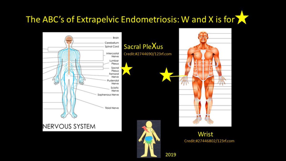 XtraNotRare's tweet photo. #EndometriosisAwarenessMonth Today’s letters of the ‘ABC’s of Extrapelvic Endometriosis’ is W and X. W is for #Wrist and X is for #SacralPleXus. Learn more @ https://t.co/ZNqofkZ1Ib https://t.co/MFuGxObWEp