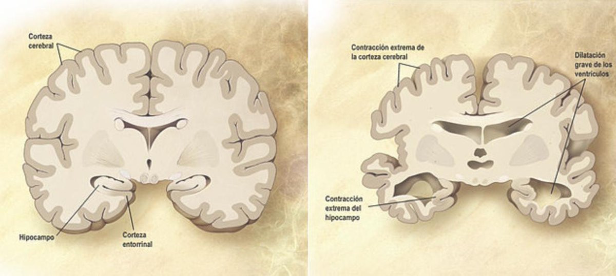OpkoHealthEurop's tweet photo. ¿Puede seguir rejuveneciéndose el cerebro en la vejez?

Se ha dicho que las neuronas son células que no se regeneraban.Nacías con un número muy elevado y hasta que acababa el crecimiento seguían aumentado de número pero luego en la madurez  no había más.

https://t.co/1SPCvDYEgs https://t.co/JlvXJZ5gBb