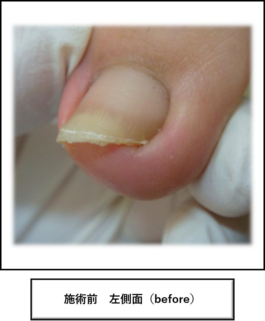 巻き爪のペディグラス 細川慶一 軽度の巻き爪でも痛みが強い場合は爪の先端にトゲができている可能性があります 痛みの原因がわからないまま化膿してしまう恐れもございますので こんな時は是非ペディグラス千林大宮店へご相談ください Hp T 巻き爪のペディグラス 細川慶一 軽度の巻き爪でも痛みが強い場合は爪の先端にトゲができている可能性があります 痛みの原因がわからないまま化膿してしまう恐れもございますので こんな時は是非ペディグラス千林大宮店へご相談ください Hp T