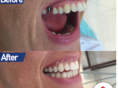 MontrealClinics's tweet photo. Our #dental_implants treatment:
⠀ ✔️ #Same_day_dental_implants. Single or full mouth Implant insertion and temp crown in one day!
⠀ ✔️Lifetime warranty
⠀ ✔️US made, FDA approved implants
⠀ ✔️Specialist implantologist accredited by University of Lomalinda, California
#dental https://t.co/8F9MWRP3TG