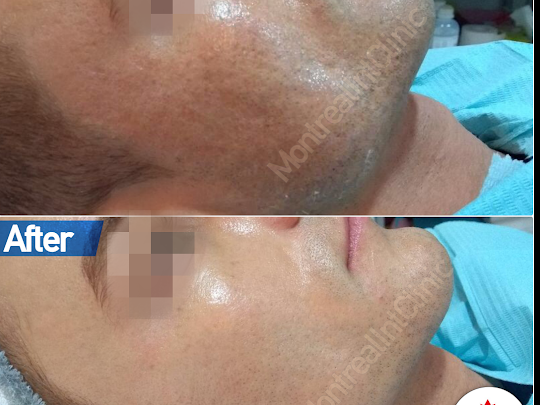MontrealClinics's tweet photo. Get a smooth healthy glowing skin with Fractional CO2 Laser Treatment!
#MontrealIntClinic #cosmetology #skincare #acne #postacne #scars #pigmentation #antiaging #fractionallaser #co2laser #peeling #beforeandafter #Dubai #dxb #mydubai
https://t.co/UBQJWHZYcd https://t.co/VREr8VpcTF