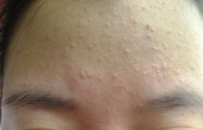 kocaelidevhst's tweet image. Akne nedir ?
✅#Akne, #yüz, sırt ve gövdede yer alan yağ bezlerinin aktivitesiyle oluşan #sivilceler dir.
✅#Ergenlik ve erişkin aknesi olarak iki tipi vardır.
✅Gençlerin % 85'i bir dönem akneden etkilenir.
✅Erkeklerde, daha şiddetli ve inatçı formlarda görülebilir

#cilt #salı