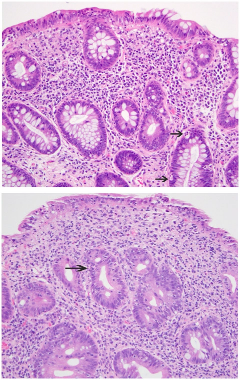 JournalCancer's tweet photo. New #CancerCaseConundrums | Lymphocytic colitis‐like pattern of mucosal injury and the challenges in diagnosing cancer immunotherapy‐related toxicity https://t.co/T0rLtx4Qfb authored by @BrighamWomens researchers https://t.co/CzKgyUqZ5h