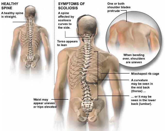 ScoliosisSOS's tweet photo. Signs of #scoliosis  - what to look out for: https://t.co/lpbkj59drx https://t.co/hGeaHBRGOh