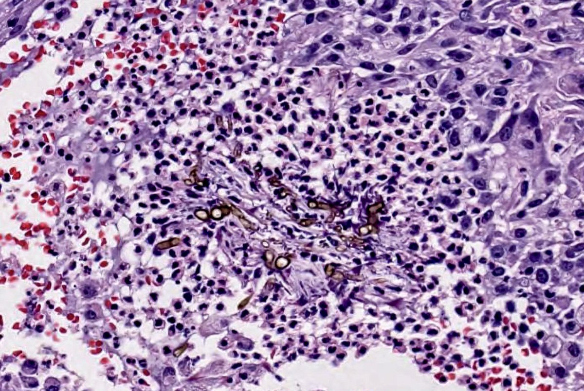 Phaeohyphomycosis diverse group of pigmented molds commonly in soil and wood and enter skin through trauma. Hyphae=phaeohypho, chromo=no hyphae. Cystic cavity - mixed inflammation with giant cells, histiocytes, and neutrophils. #Dermpath #Dermatology #pathology