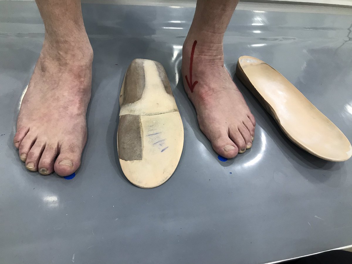 pododeportiva's tweet photo. #pieplano adquirido del adulto por insuficiencia del #tibialposterior https://t.co/UXae4TJmd7