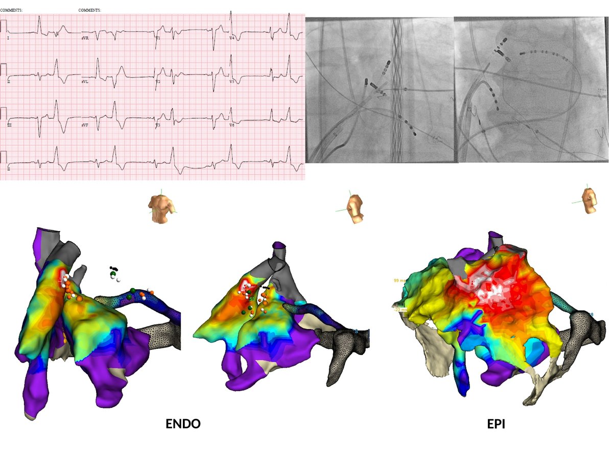 Andres Enriquez (@andresenriqueza) on Twitter photo Intramural PVC. Successful bipolar ablation from RVOT and LVOT. Nonischemic cardiomyopathy with 40-50% PVC burden. 3 prior failed ablations, including epicardial <a href="/JasonBaley/">Jason Baley</a> <a href="/victorneirav/">Victor M. Neira Vidal, MD, DRCPSC, FACC</a> <a href="/GBisleri/">Gianluigi Bisleri, MD</a> <a href="/adribaran/">Adrian Baranchuk MD FACC FRCPC FCCS FSIAC</a> <a href="/Dr_Santangeli/">Pasquale Santangeli</a> <a href="/DrFerminGarcia/">Fermin Carlos Garcia</a> <a href="/drluissaenz/">Luis C. Saenz, MD</a> @DavidBriceno_EP Intramural PVC. Successful bipolar ablation from RVOT and LVOT. Nonischemic cardiomyopathy with 40-50% PVC burden. 3 prior failed ablations, including epicardial <a href="/JasonBaley/">Jason Baley</a> <a href="/victorneirav/">Victor M. Neira Vidal, MD, DRCPSC, FACC</a> <a href="/GBisleri/">Gianluigi Bisleri, MD</a> <a href="/adribaran/">Adrian Baranchuk MD FACC FRCPC FCCS FSIAC</a> <a href="/Dr_Santangeli/">Pasquale Santangeli</a> <a href="/DrFerminGarcia/">Fermin Carlos Garcia</a> <a href="/drluissaenz/">Luis C. Saenz, MD</a> @DavidBriceno_EP