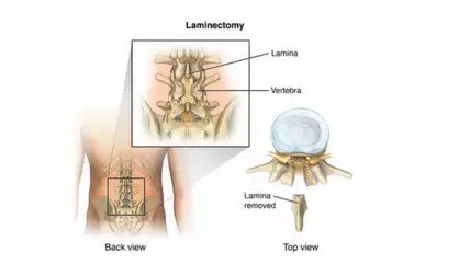 DrSusmitNaskar's tweet photo. Lumbar Laminectomy for Spine or #Spine Decompression in India
Are you suffering from #spinal or any other related pain? Request an appointment with Dr. #Susmit Naskar today. Visit https://t.co/bH9ibCgx1v for appointment.
#Lumbar #Laminectomy https://t.co/5F6WAohdco
