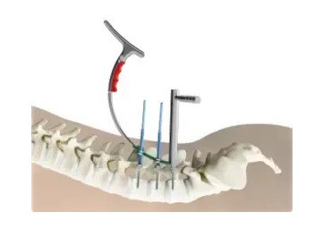 DrSusmitNaskar's tweet photo. Minimally Invasive Spine Surgery in India
Are you suffering from #spinal or any other related pain? Request an appointment with Dr. #Susmit Naskar today. Visit https://t.co/bH9ibCgx1v for appointment.
#Lumbar #Laminectomy https://t.co/1685nsVPSG