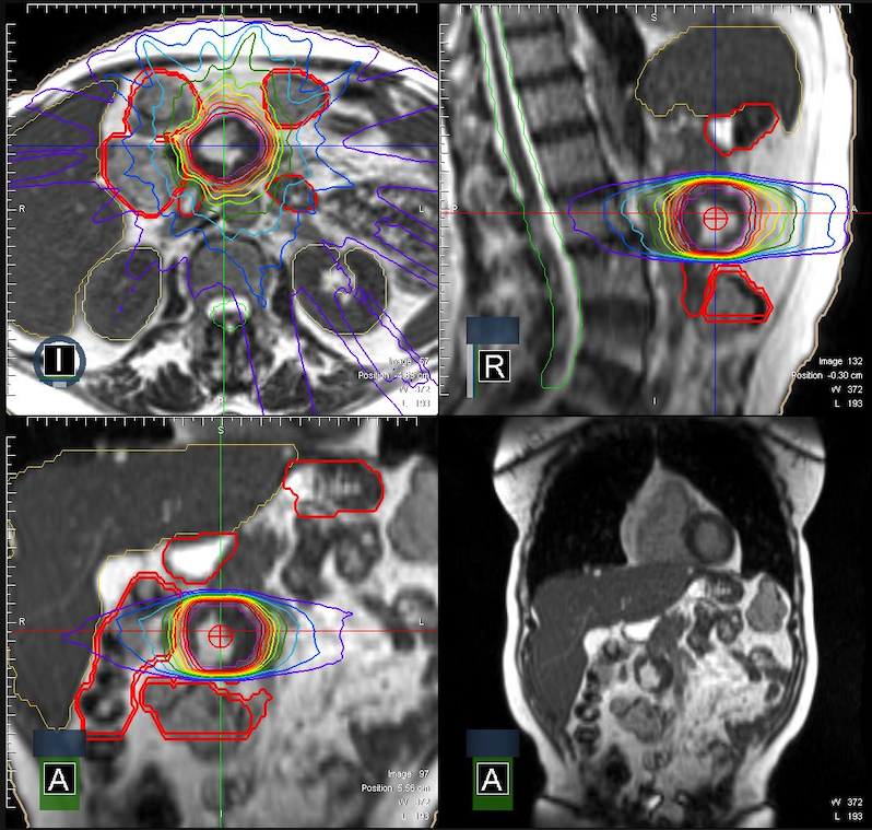 ViewRay (@viewray) on Twitter photo Calling all #Oncology19 dosimetrists & therapists: come by stand 980 <a href="/OncologyExpo/">Oncology Convention</a> for a treatment planning system demonstration. Learn about #MRIdian - the world’s first MRI-Guided radiation therapy system to image and treat cancer patients simultaneously. Calling all #Oncology19 dosimetrists & therapists: come by stand 980 <a href="/OncologyExpo/">Oncology Convention</a> for a treatment planning system demonstration. Learn about #MRIdian - the world’s first MRI-Guided radiation therapy system to image and treat cancer patients simultaneously.