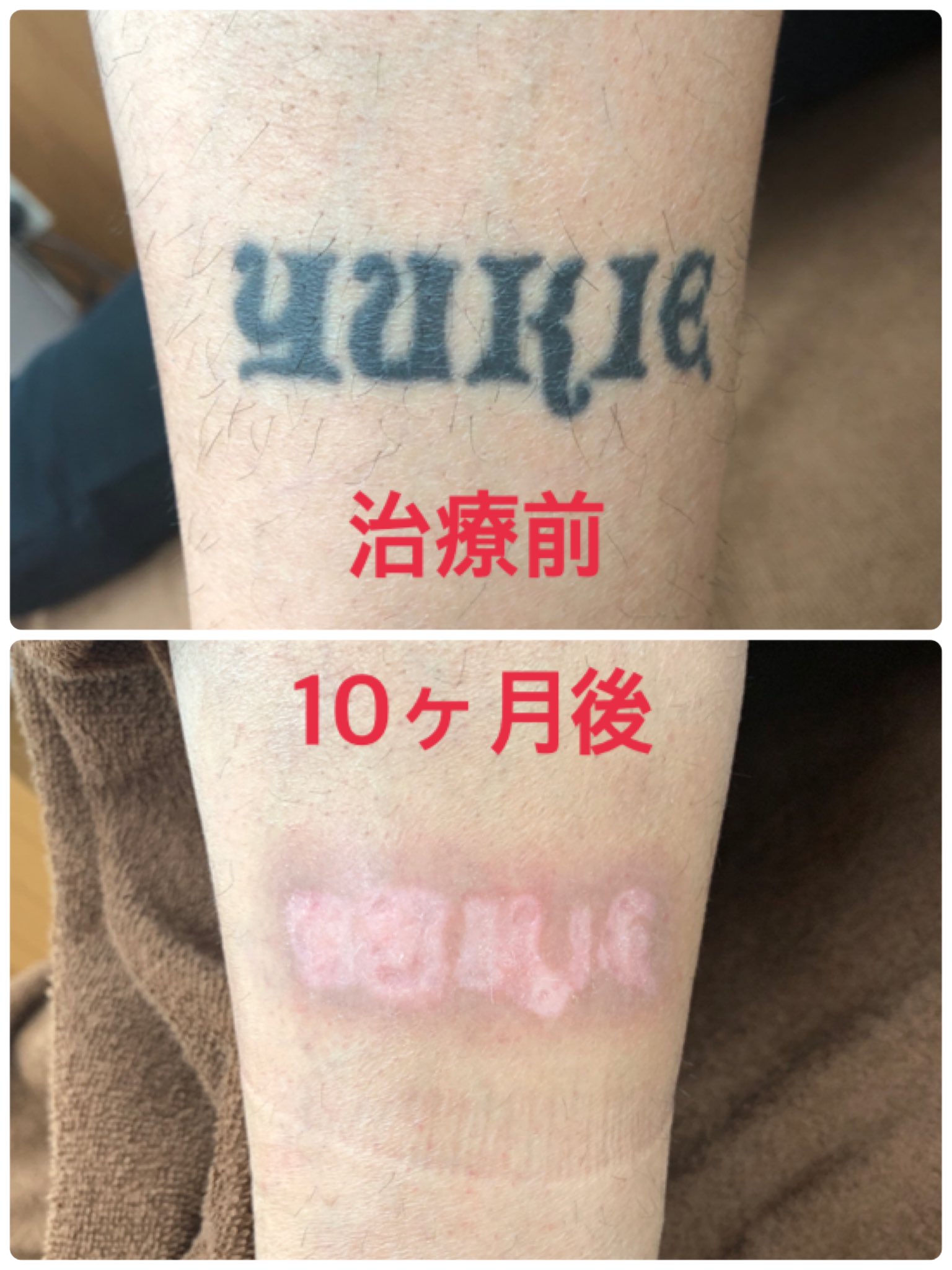 キルシェクリニック Dr めかた 消えづらい足のタトゥー が 10ヶ月でここまで消せたら良好な結果ですね もうプールもお風呂も隠す必要なし 色素沈着などが落ち着く半年後には さらに目立たなくなっていますよ ピコ レーザーならではの結果です タトゥー