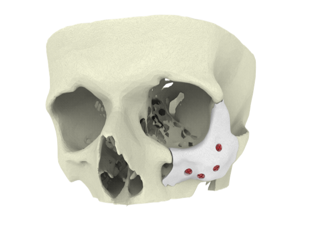HealthTechPulse's tweet photo. 3D-printed, bioactive bone implants recognised by Royal Academy of Engineering @RAEngNews as marvel of modern engineering

https://t.co/y49WPTgZAn

#healthtech #engineering #3Dprinting #Bones https://t.co/qEY6rLr7Dr