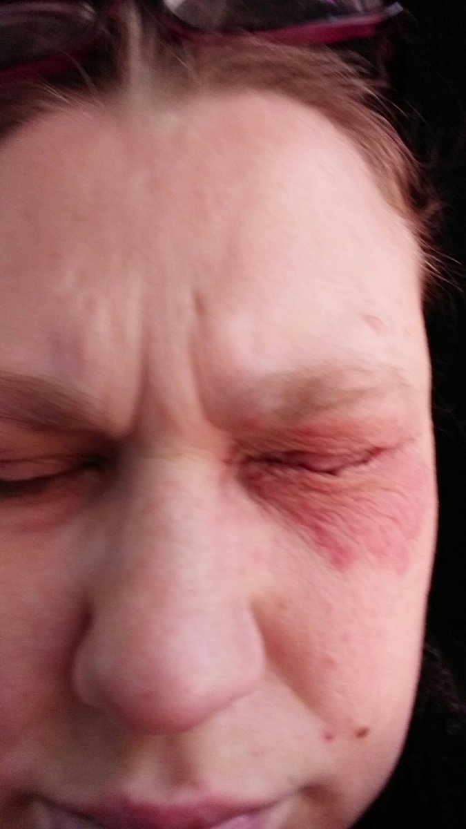 AFarrald's tweet image. Going to the pharmacy to pick up meds for this. It is along the lines of poison ivy. Just a little over a week after I was told it was pink eye. Hopefully it clears up soon. Either way there is a reason to praise God.