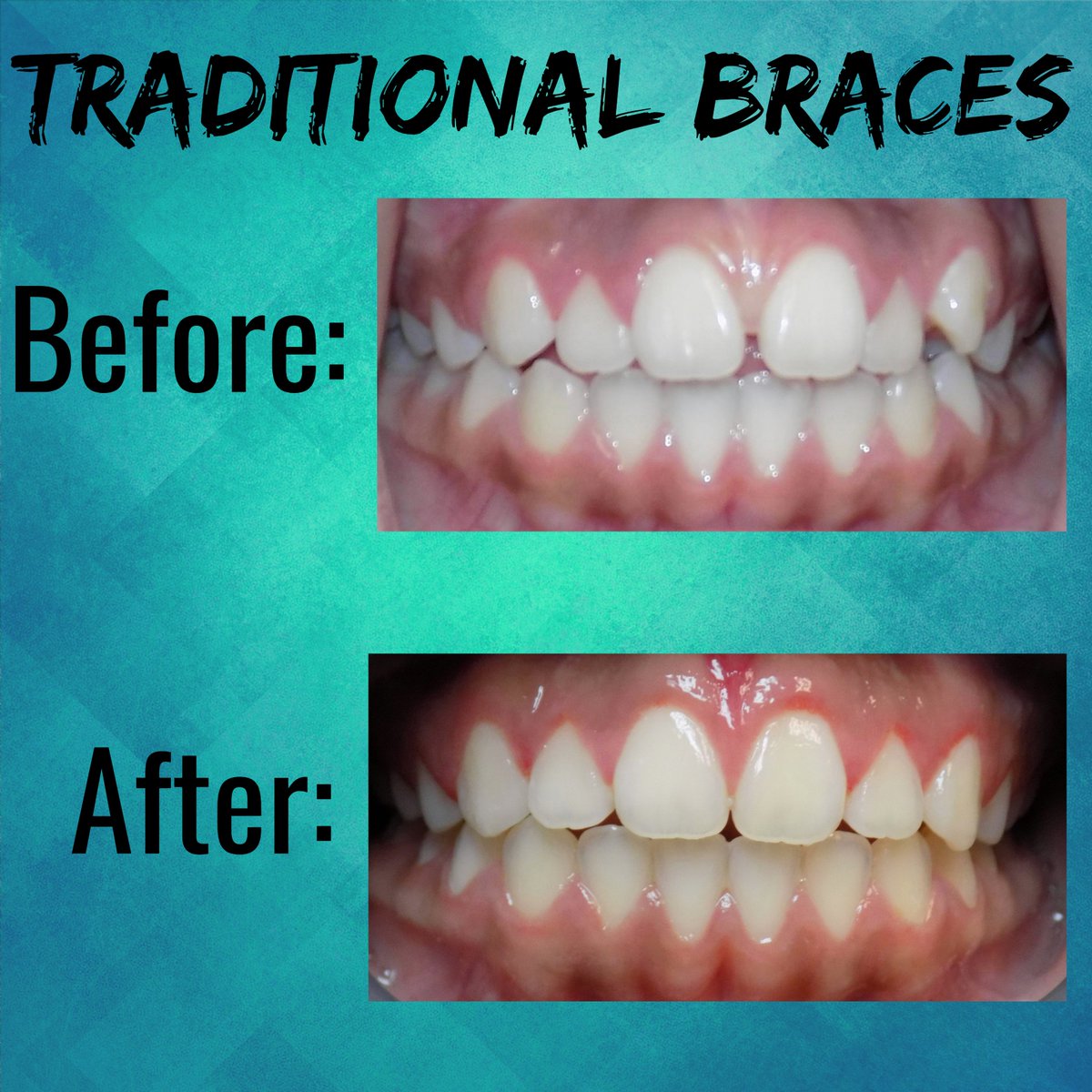 After 2 years of Traditional braces our little patient is ready to show off her pearly whites just in time for high school! 😁
#novandental #traditionalbraces #beforeandafter