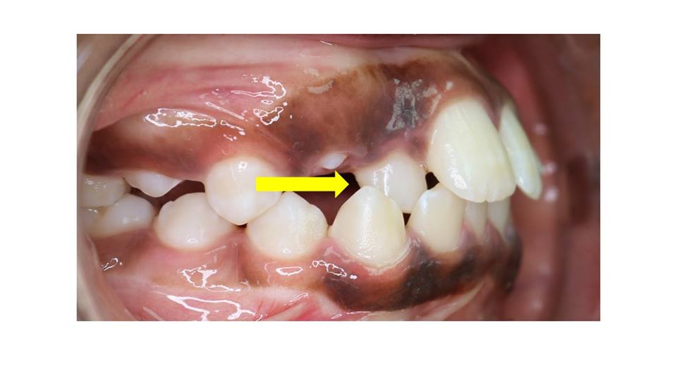 Orleans_Ortho's tweet image. Crossbites of #frontteeth should be corrected as soon as possible to prevent chipping and wear. Top teeth should always be placed outside the lower teeth. #OrleansOrthodontics #SmilesBySaikaly #Orthodontics #OttawaDental