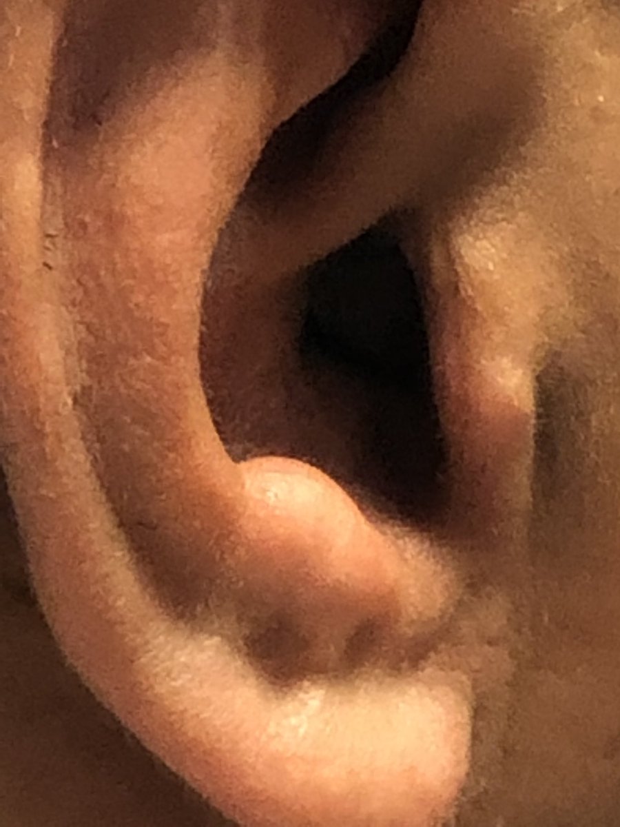 HIPSBC's tweet image. When they say #invisible they mean it! This is a close up of a #patient ear canal with a IIC #InvisibleInCanal #hearingaid ! This is one from @ReSoundGlobal but most offer this option. See your #RegisteredHearingHealthcareProfessional #cshhpbc