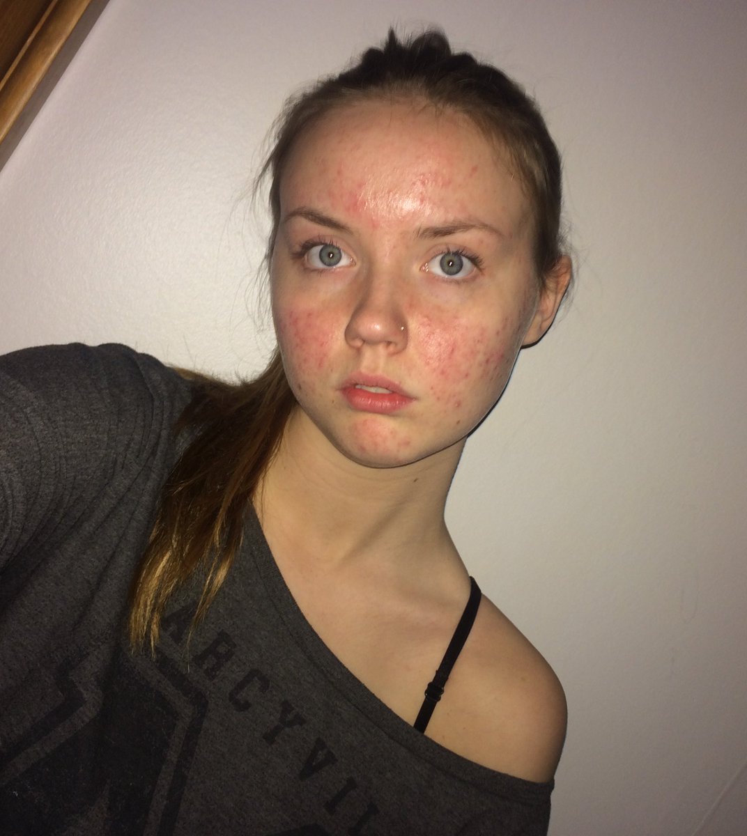 slutjjk's tweet image. this is how my social anxiety started and developed into depression, this made me unable to look people in the eye because i was so disgusted by myself, i still can’t do it but i’m making progress, today i barely get a single pimple thanks to accutane, it truly saved my life.