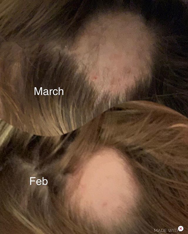 DocKatniss's tweet photo. STOP EVERYTHING!!! I have an update!!!!!! #ahhhhh #alopecia #growingback 🙌🏽🙌🏽😊😊😊😊 https://t.co/2AnXOKsIlt https://t.co/rkpLl5vrpl