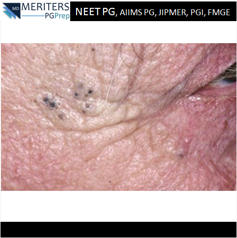 pg_prep's tweet photo. What is your diagnosis?
1.Acne vulgaris
2.Colloid milium
3.Favre and Racouchot disease
4.Sebaceous hyperplasia
5.Syringomas

#NEET_PG #AIIMS #JIPMER #PGI #DNB #Medicine #PG_Medical_Entrance #NEETPG #MedicalEntrance #Doctor #Medical #PGPrep #ImageMCQs #NEET_Mock_Test #Anaesthesia https://t.co/CkqQiwIXSs