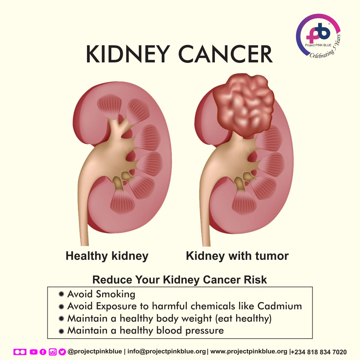 Kidney Cancer From Smoking