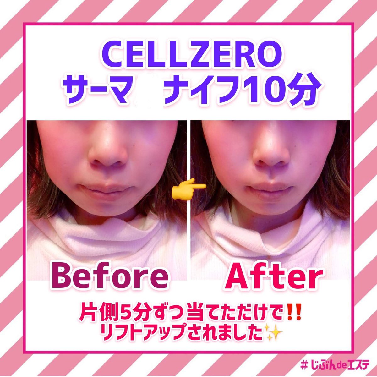 サーマナイフチップ　4個新品　じぶんdeエステ サーマナイフチップ 新品 じぶんdeエステ