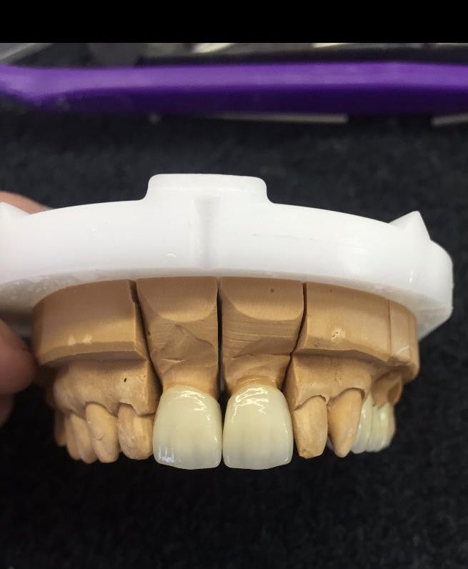 optimum_dental's tweet image. #3unitbridge for the #upper 4,5 &amp;amp; 6 and #2single #units for the upper #1s #beautiful #work by @hannah.cholerton @optimum_dental #ivoclar #ivoclarvivadent #emax #emaxveneers #optipoints #dla #teeth #dental #dentist #translucent #translucentpowder #smile #emaxpress