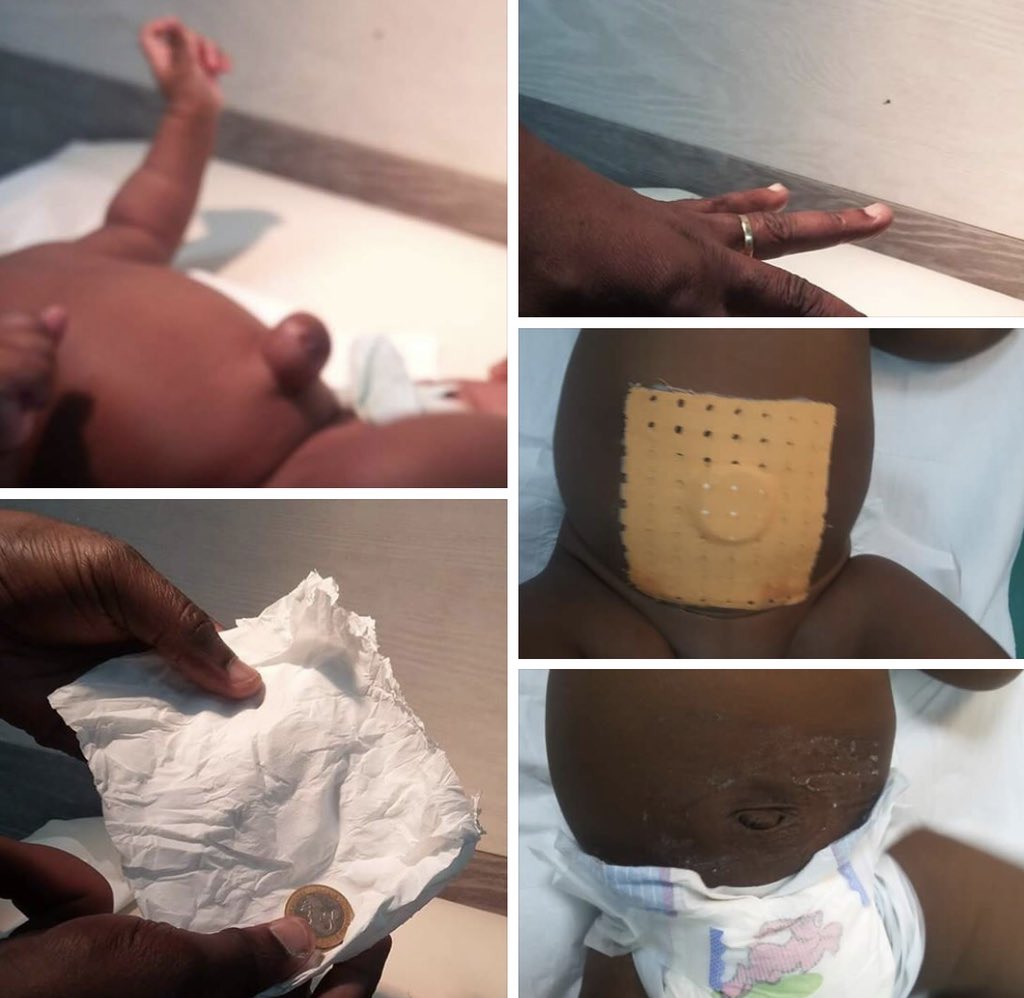 Eva Amani Na Twitteru Pour Les Parents Dont Les Nourrissons Souffrent De Hernie Ombilicale Voici Une Astuce Simple Et Efficace Qui Peut Eviter A De Passer Par La Chirurgie T Co 7uvtfdjlkx