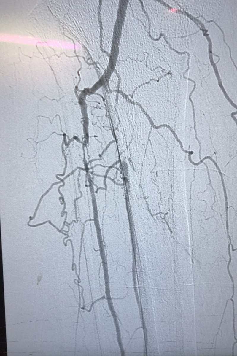 drmkmittal's tweet image. 68yof, RF5, 8x10 wound medial leg, had 1v run off pre, opened CTO AT and TP, AG for PT and RG for AT, POBA c/ 2.0 and 3.5 🎈 what wud you do next? 👇🏼 for poll