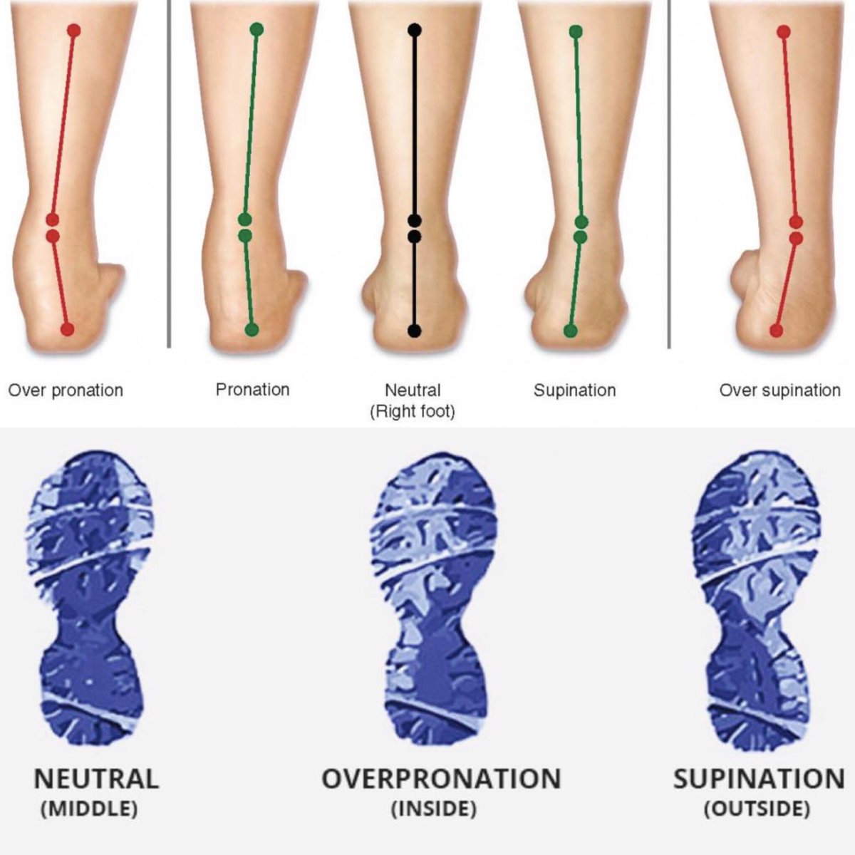 Supination of Foot and Oversupination